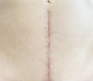 手術4カ月後の傷跡