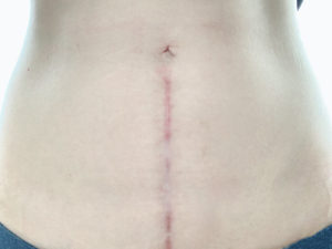 子宮摘出手術7ヶ月後の傷の様子